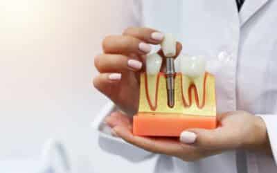 How to Find The Best Dental Implant Specialist in Stillwater