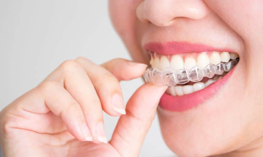 How Does Invisalign Move Your Teeth