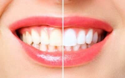 How Teeth Whitening Services Can Boost Your Confidence?