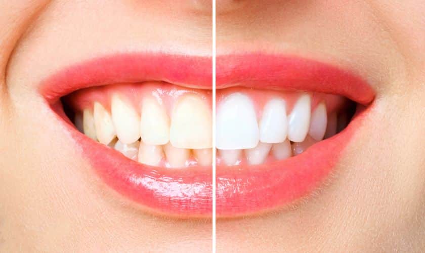 Teeth Whitening Services Stillwater