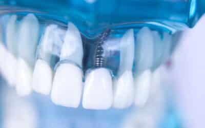 Latest Advancements in Dental Implant Surgery Techniques