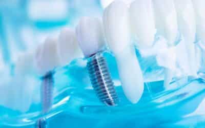 Smart Solutions for Dental Implant Success