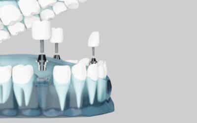 8 Best Alternatives to Dental Implants