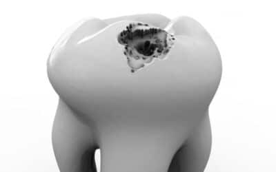 How to Fix a Hole in Your Tooth Without a Dentist?