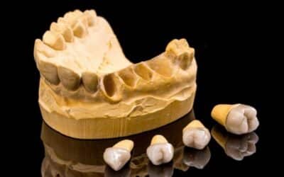 What Causes Dental Crowns to Fall Out?