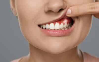 Why Do I Have a White Spot on My Gum? Common Causes and When to See a Dentist