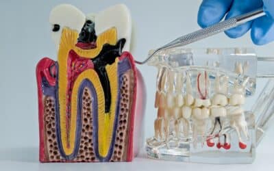 The Truth About Root Canal Therapy: Myths vs. Facts