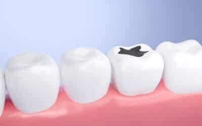 Tooth Decay Explained: Symptoms, Causes & How to Prevent It