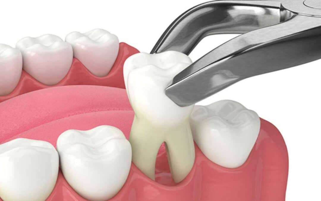 Speed Up Healing After Tooth Extraction