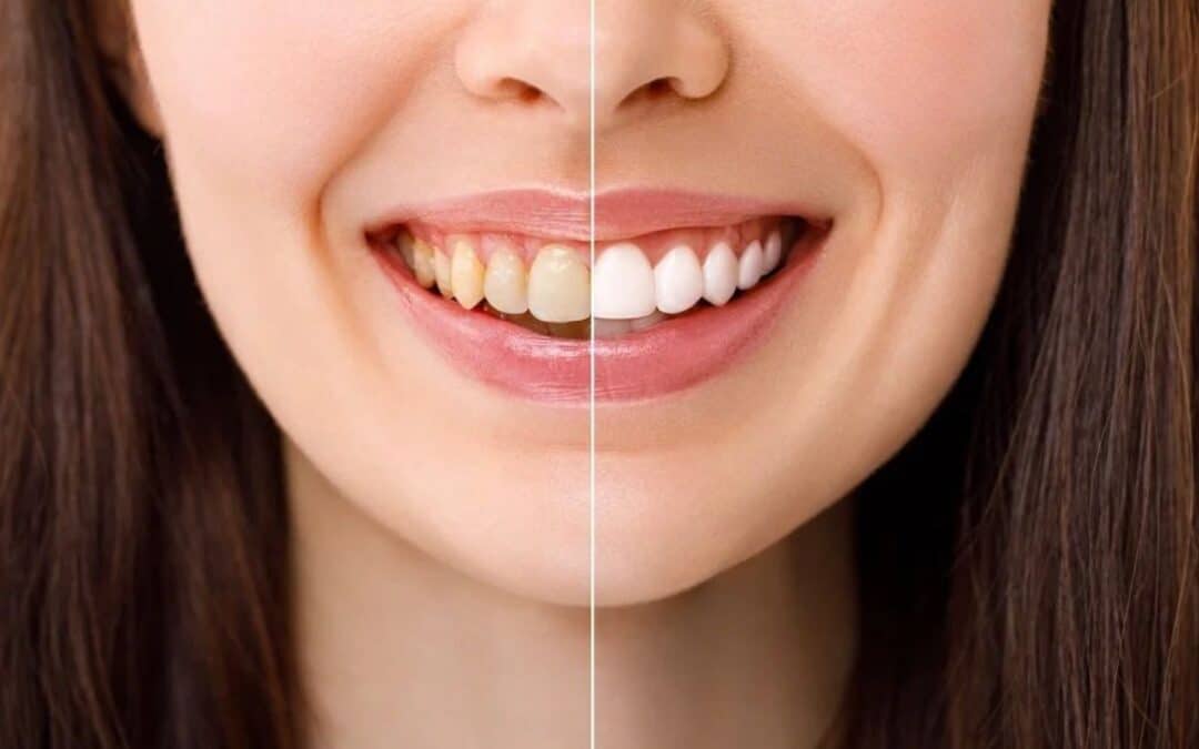 Common Reasons for Yellow Teeth and How to Treat Them
