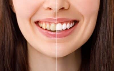Common Reasons for Yellow Teeth and How to Treat Them