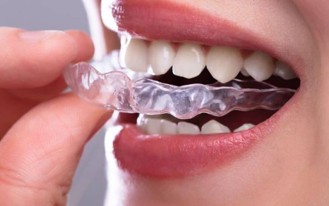 Close-up view of clear Invisalign aligners on teeth