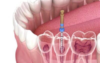 Do Root Canals Work For Cracked Teeth?