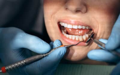 You Brush Every Day—So Why Do You Still Get Cavities?